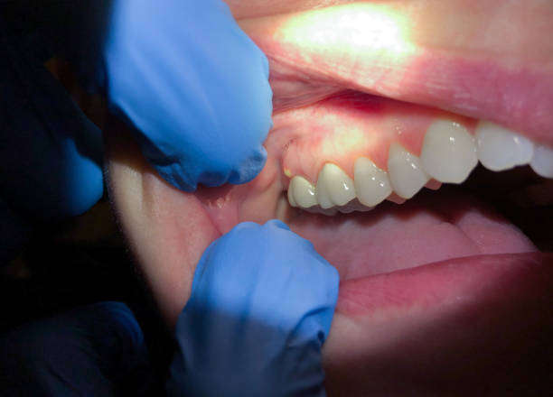Best Broken or Cracked Tooth Emergency Dentist in High Point, NC